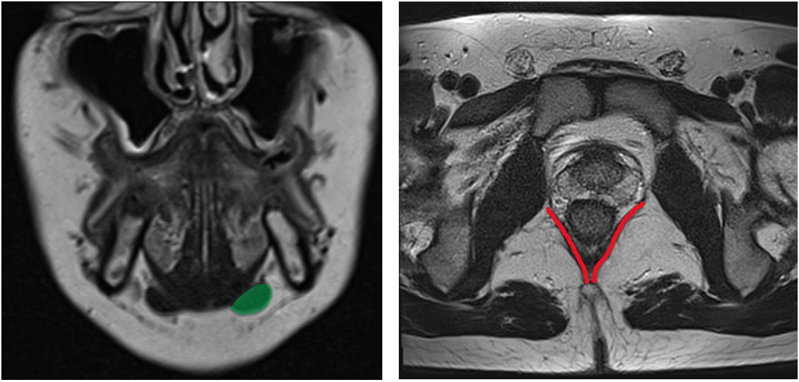 Immagini RM T2: a sinistra il ventre anteriore del muscolo digastrico nel collo (overlay verde), a destra il muscolo pubo-coccigeo nel pavimento pelvico (overlay rosso)